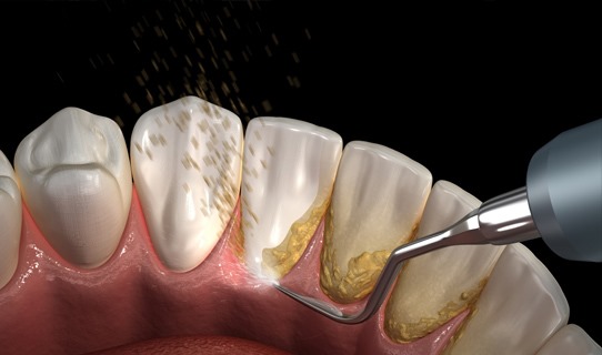 Limpieza dental destartraje